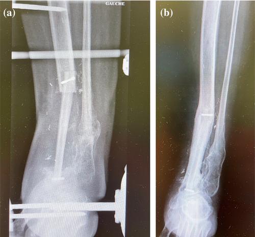 Long-term outcome of fibula flaps in complex limb reconstruction compared to alternative procedures, a median follow up of 41 months