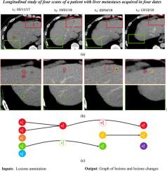 A graph-theoretic approach for the analysis of lesion changes and lesions detection review in longitudinal oncological imaging