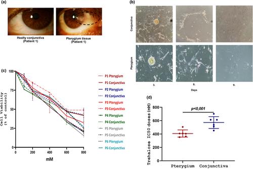 Integrative analysis of ex vivo studies and microarray reveals the novel inhibitor effects of trehalose on the pathogenesis of pterygium