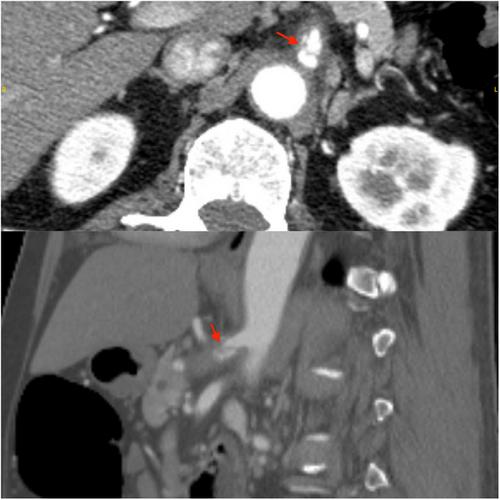 Man with hypertension and abdominal pain