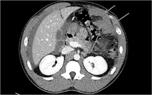 Hidden hemorrhage: A case of idiopathic omental hemorrhage causing spontaneous hemoperitoneum