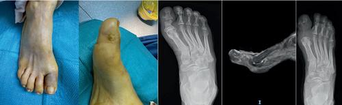 The diabetic sausage toe: Prevalence, presentation and outcomes