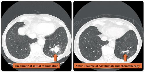 Successful Application of Tocilizumab in a Patient With Neoadjuvant Immunochemotherapy-Induced Cytokine Release Syndrome