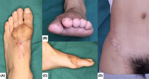 Immediate foot reconstruction and revascularization of toes using an interposition superficial circumflex iliac artery perforator flow-through flap: A case report