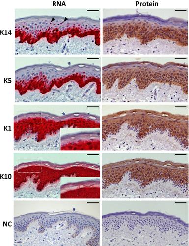 Loss of keratin 14 expression from immortalized keratinocytes by promoter methylation