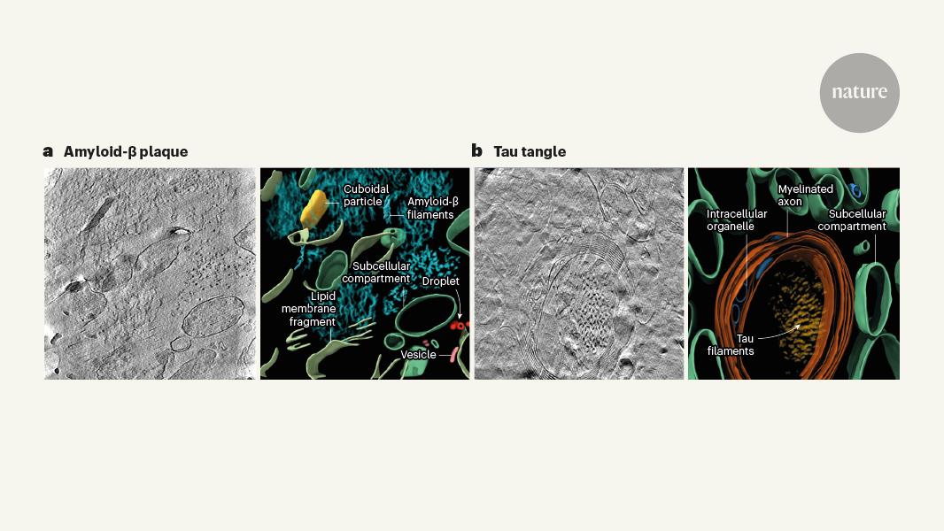 Alzheimer’s plaques and tangles revealed by 3D microscopy