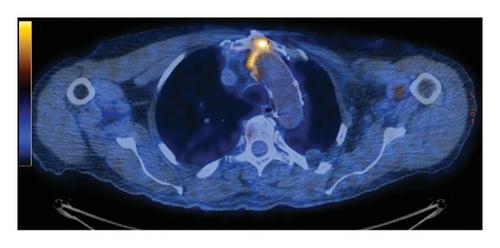 Exploring Thoracic Aortic Graft Infection: A Comprehensive Review of Diagnosis and Treatment Options with a Management Strategy Algorithm