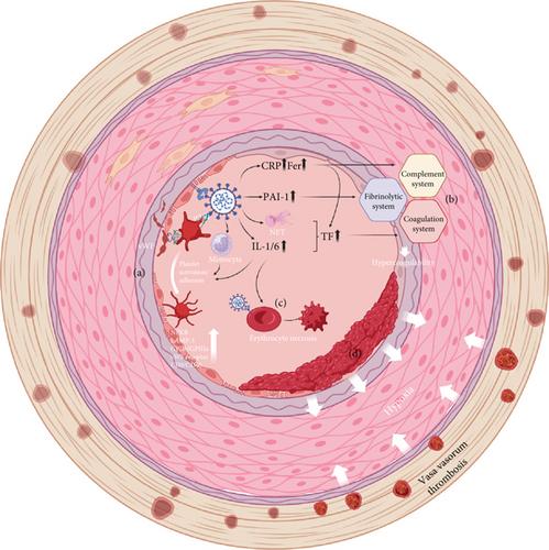 The Impact of COVID-19 Infection on Abdominal Aortic Aneurysms: Mechanisms and Clinical Implications