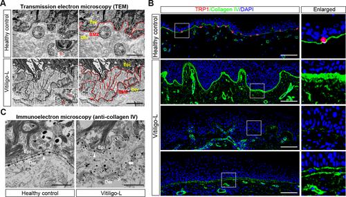 Disorganisation of basement membrane zone architecture impairs melanocyte residence in vitiligo