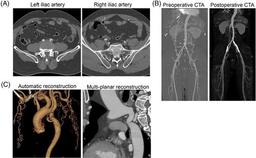 Coarctation of the aorta complicated with bilateral iliac artery dissection: A rare case