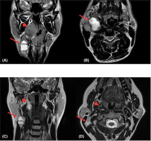 Circulating tumor HPV DNA in the management of HPV+ oropharyngeal cancer and its correlation with MRI