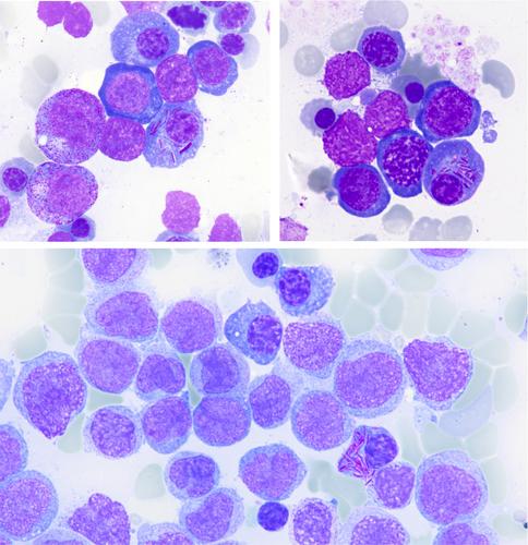 Plasma cells with Auer-rod-like inclusions in a patient with MGUS and acute myeloid leukaemia with NPM1 mutation