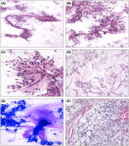 Cytological features of ependymal and choroid plexus tumours