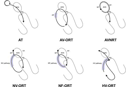 SVT quest: The adventure diagnosing narrow QRS tachycardia