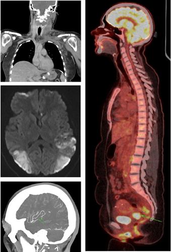 Catastrophic venous and arterial thrombosis in a young female with cervical cancer