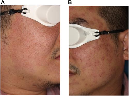 Exploring Fractional Pigment Toning: A Novel Approach for Treating Benign Pigmented Lesions in Asian Patients With Fitzpatrick Skin Types III–V