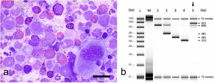 Treatment-free remission after third-line therapy with asciminib in chronic myeloid leukemia with an atypical e19a2 BCR::ABL1 transcript and T315I mutation