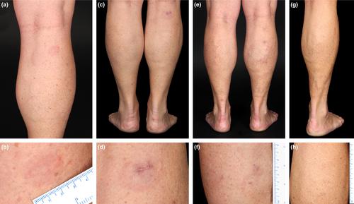 Spontaneous regression of primary cutaneous diffuse large B-cell lymphoma, leg type: A case series and review of the literature