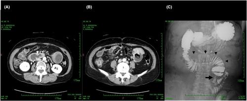 Primary adenocarcinoma of the upper jejunum