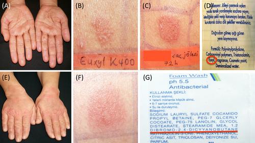 High prevalence but no current clinical relevance of methyldibromo glutaronitrile since its ban in Turkey in 2015