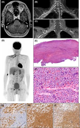 Isolated peripheral nervous system relapse after allogeneic hematopoietic cell transplantation for T-cell acute lymphoblastic leukemia