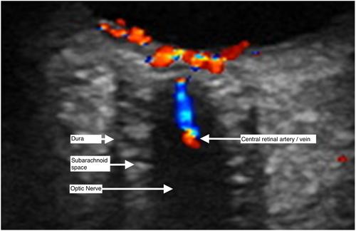 Which compartments of the optic nerve and its sheath are associated with intracranial pressure? An exploratory study