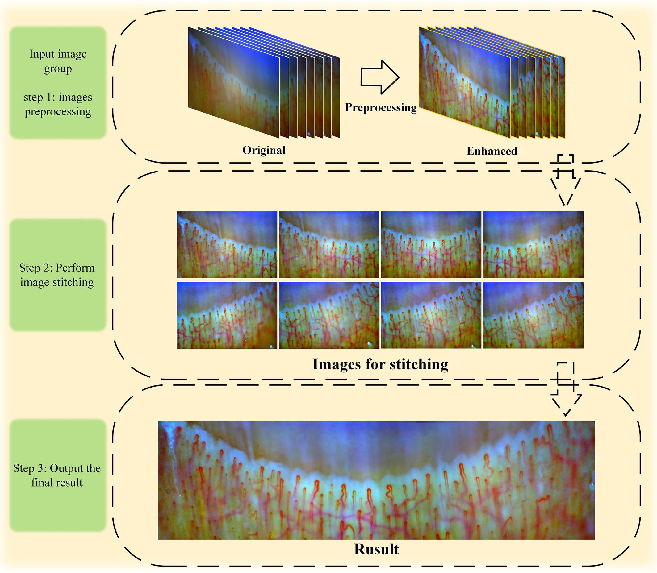 Stitching method for panoramic nail fold images based on capillary contour enhancement