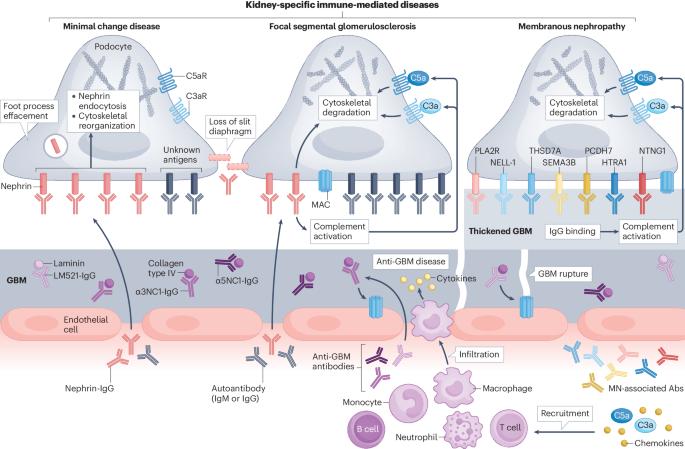 Anti-nephrin autoantibodies: a paradigm shift in podocytopathies