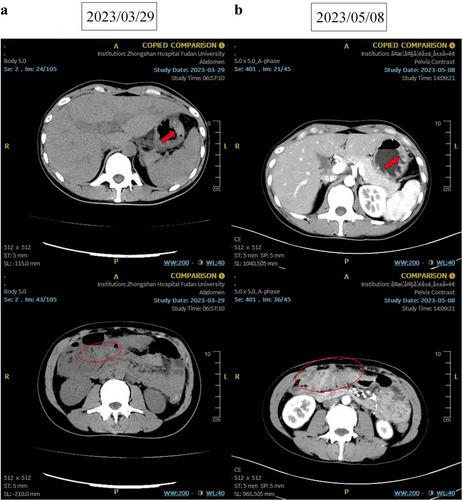 Persistent response to combination treatment of pemigatinib and chemotherapy in a patient with advanced gastric cancer: A case report