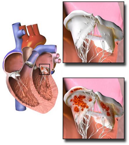 Bacteriophage therapy and infective endocarditis – is it realistic?