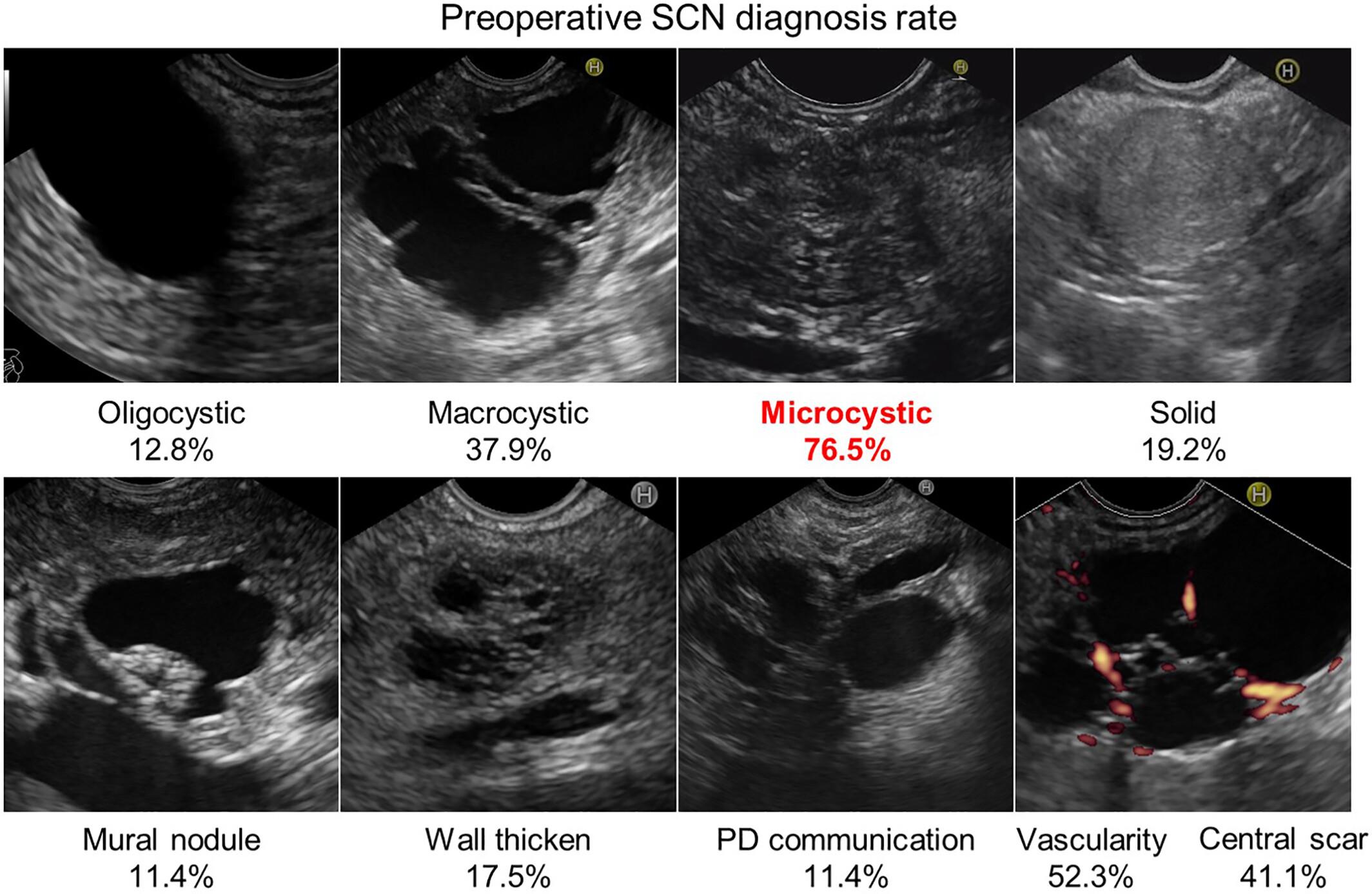 Reassessment of EUS features in preoperative diagnosis of pancreatic serous cystic neoplasm: Lessons to avoid misdiagnosis