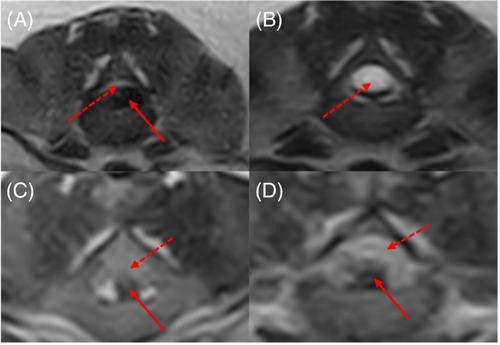 Recovery of ambulation in small, nonbrachycephalic dogs after conservative management of acute thoracolumbar disk extrusion