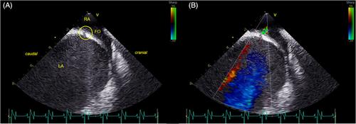 Intracardiac ultrasound-guided transseptal puncture in horses: Outcome, follow-up, and perioperative anticoagulant treatment