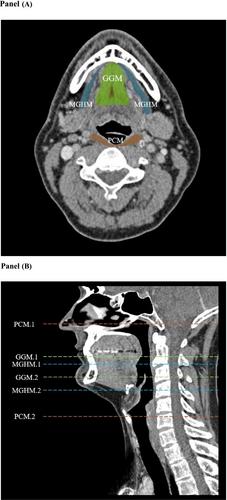 A new computed tomography-based approach to quantify swallowing muscle volume by measuring tongue muscle area in a single slice