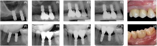 Effect of one-time placement of the definitive abutment versus multiple healing abutment disconnections and reconnections during the prosthetic phase on radiographic and clinical outcomes: A 12-month randomized clinical trial