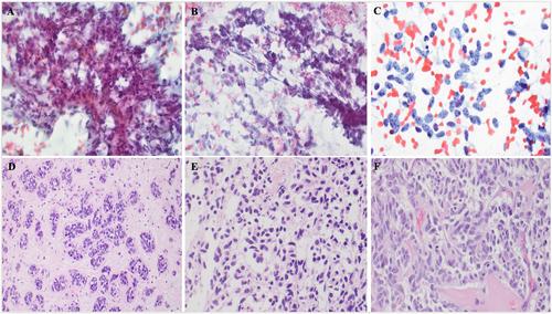 Cytomorphologic and molecular characterization of spindle cell carcinoid tumors of the lung