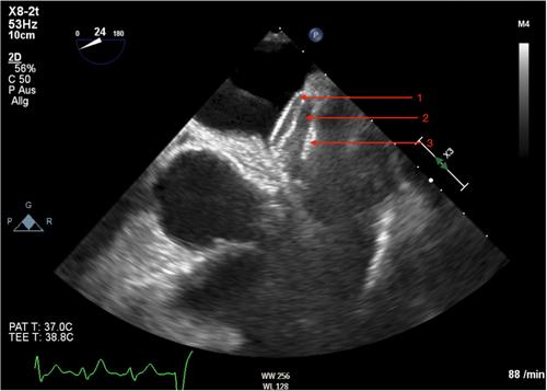 Interventional closure of an iatrogenic LAA-perforation by means of a PFO-occluder