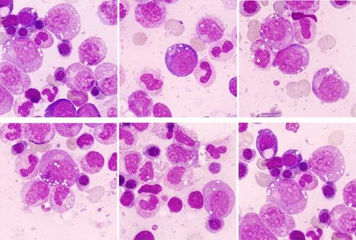 Where hematology meets rheumatology—VEXAS syndrome