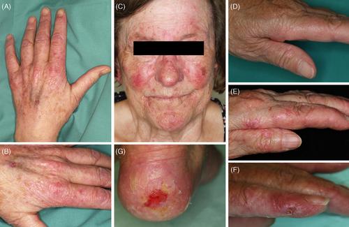 Dermatomyositis-like skin eruptions under hydroxyurea therapy conceal TP53-mutated atypical keratinocytes: A histopathologic and molecular pathologic case series