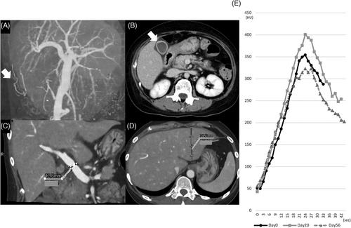 Novel method for assessing sinusoidal obstruction syndrome using four-dimensional computed tomography