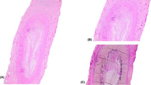 Cutaneous Langerhans cell histiocytosis and other systemic inflammatory or autoimmune disease manifestations in the setting of clonal hematopoiesis