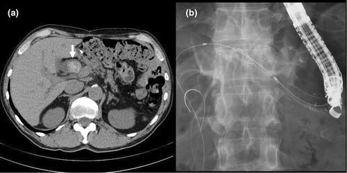 Reinsertion of a removed self-expandable metal stent through an endosonographically created route after hepaticojejunostomy for multiple cholangioscopy-guided procedures