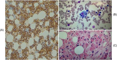 Myeloma-associated hemophagocytic lymphohistiocytosis – A comprehensive case study and a novel chemotherapy-free approach with anakinra