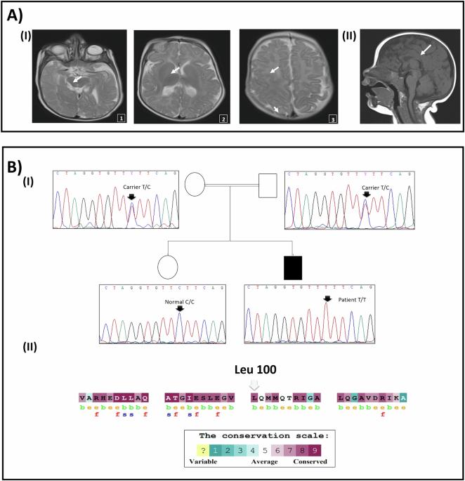 Characterization of a missense variant in COG5 in a Tunisian patient with COG5-CDG syndrome and insights into the effect of non-synonymous variants on COG5 protein