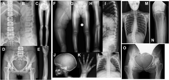 Heterozygous mutations in the straitjacket region of the latency-associated peptide domain of TGFB2 cause Camurati–Engelmann disease type II