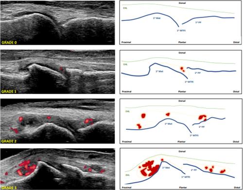 Development of an Ultrasound Imaging Atlas for Grading Osteoarthritis in the First Metatarsophalangeal Joint