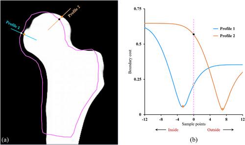 Ultra-low dose hip CT-based automated measurement of volumetric bone mineral density at proximal femoral subregions