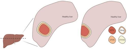 Radiomic feature robustness in CT scans affected by fiducial marker induced streak artifacts for patients with hepatocellular carcinoma