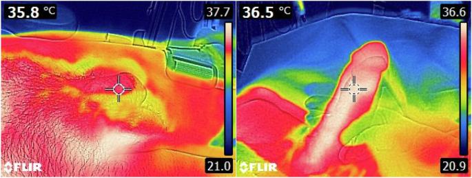 Use of thermographic imaging for the evaluation of erectile dysfunction and Peyronie’s disease