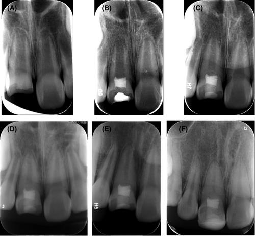 Regenerative endodontic treatment and traumatic dental injuries